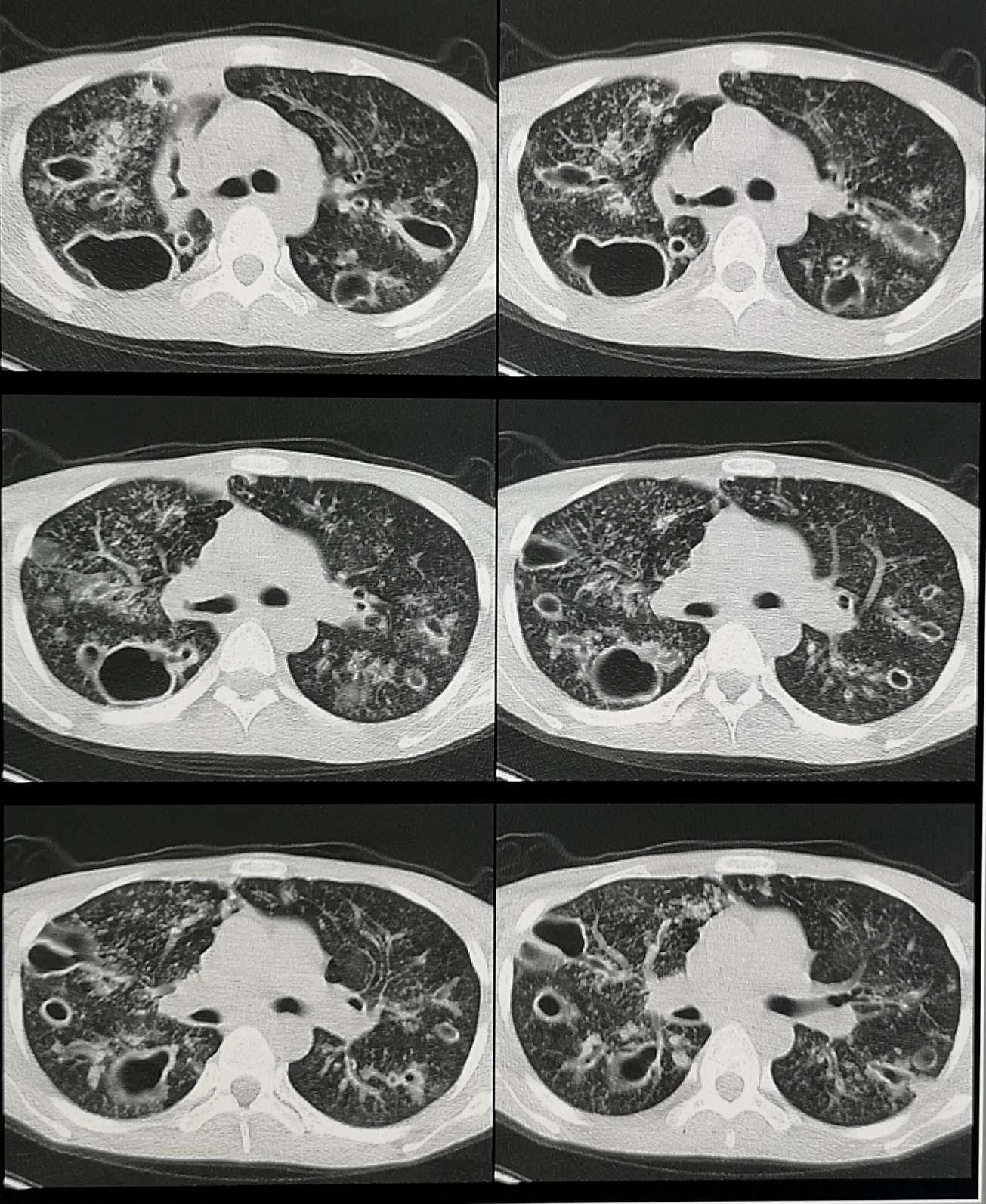 身边有肺结核病人该怎么办,身边有人肺结核我该怎么预防