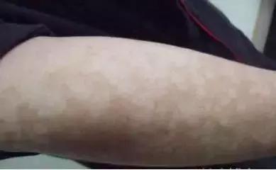 孩子脸花一块白一块怎么回事,小孩脸上花一块怎么回事