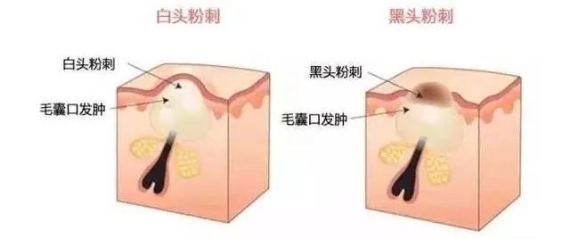 闭口怎么才能有效清理,闭口怎么处理最有效