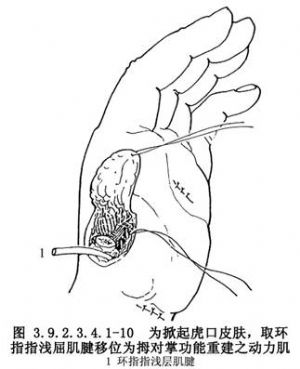 拇指再造术多少钱,拇指再造术哪里最强