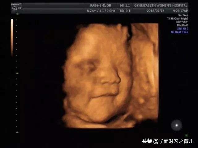 做四维检查胎儿不翻身怎么办,四维彩超常见问题分析