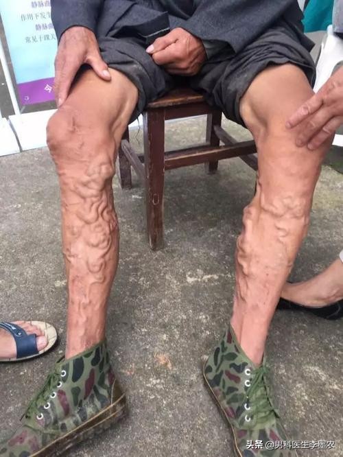 精索静脉曲张显微镜下手术危害,仰卧起坐对精索静脉曲张有危害吗