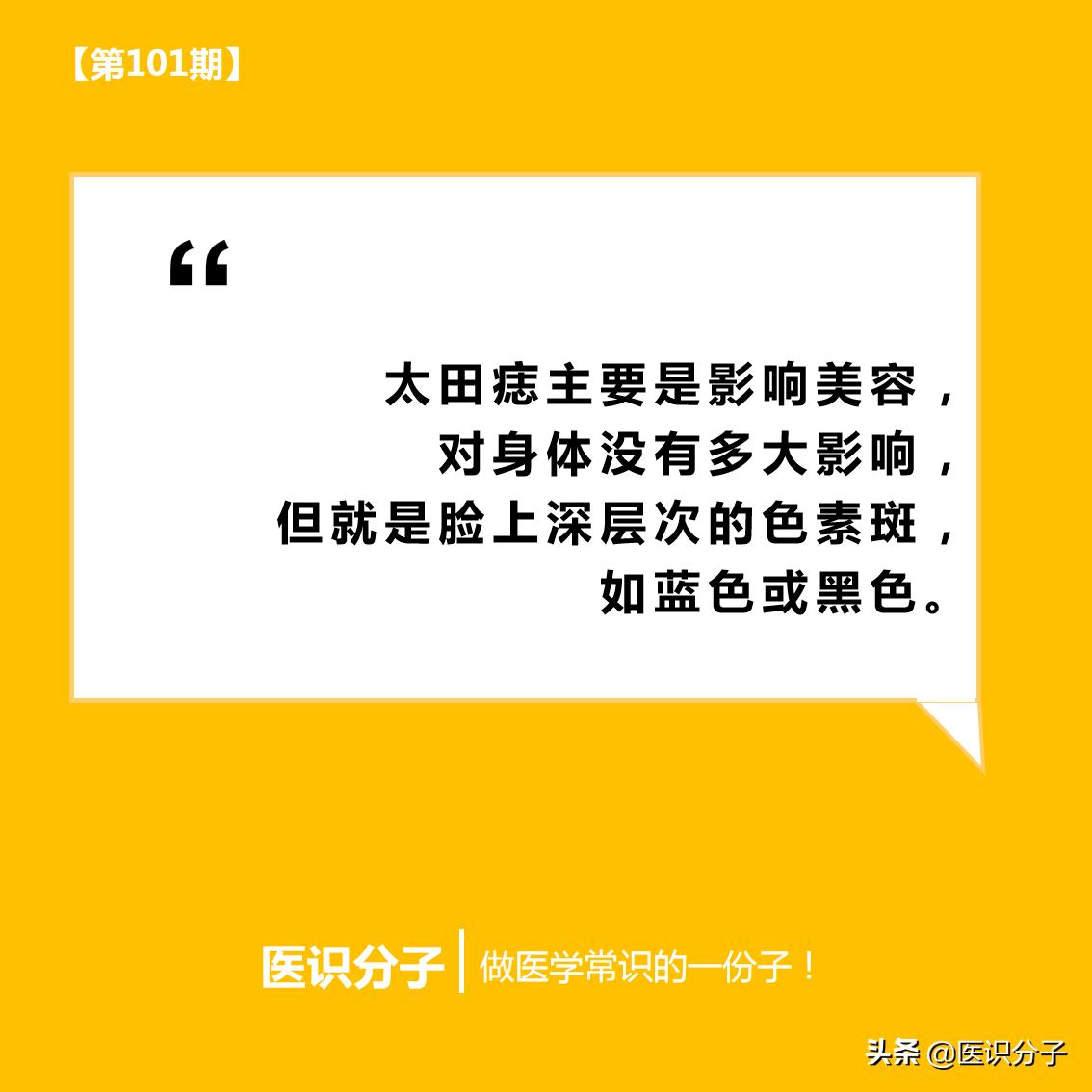 太田痣第二次激光效果,激光治疗颜色较深的太田痣