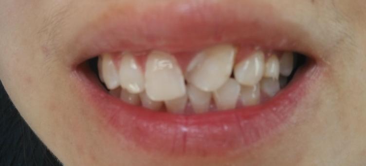 孩子龋齿要不要治疗,孩子龋齿要拔牙还是治疗