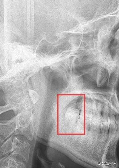 拔一颗长出来的智齿大概要花多少,拔一颗智齿前前后后花了快两千