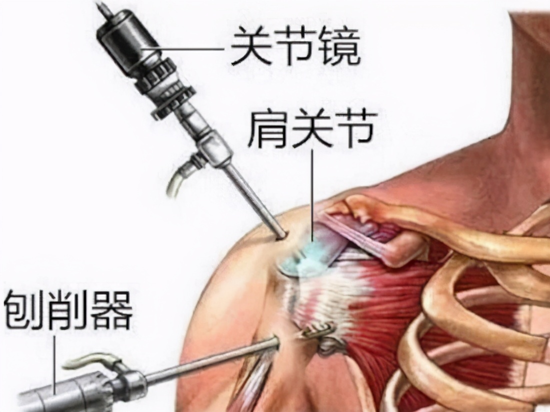 治疗肩周炎的穴位,肩周炎的治疗膏药