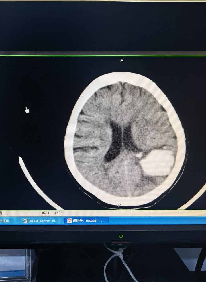 硬脑膜外血肿引流,高压氧治疗颅内出血