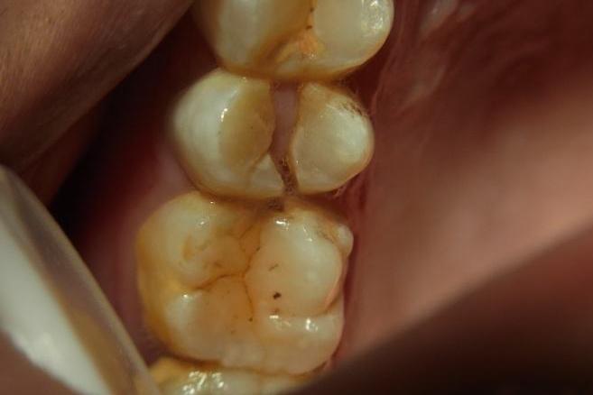 牙齿的隐形矫正,牙隐裂发生最多的牙齿