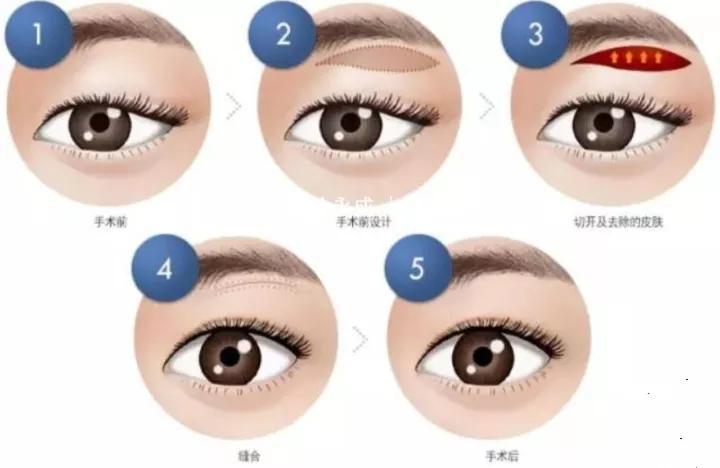 提眉手术的最佳方法图解,提眉手术有几种方法