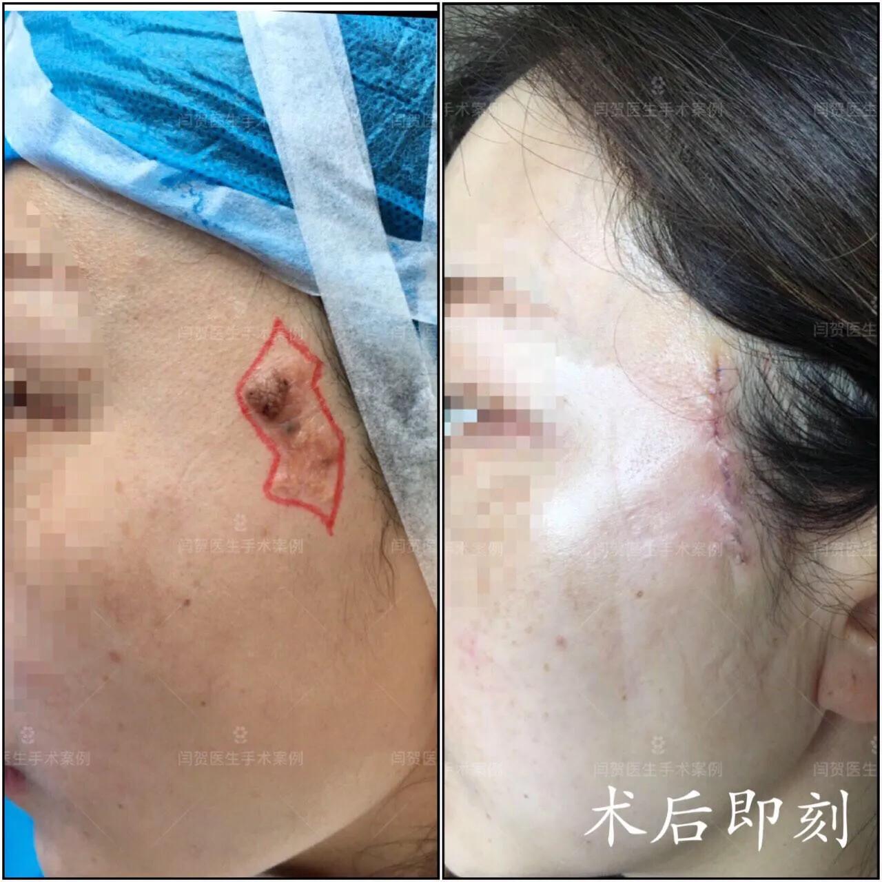 脚底有痣激光还是手术切除,黑色素痣手术切除还是激光去除好