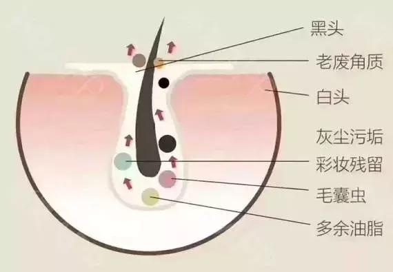 清理黑头的正确方法,清理黑头的正确方法是什么