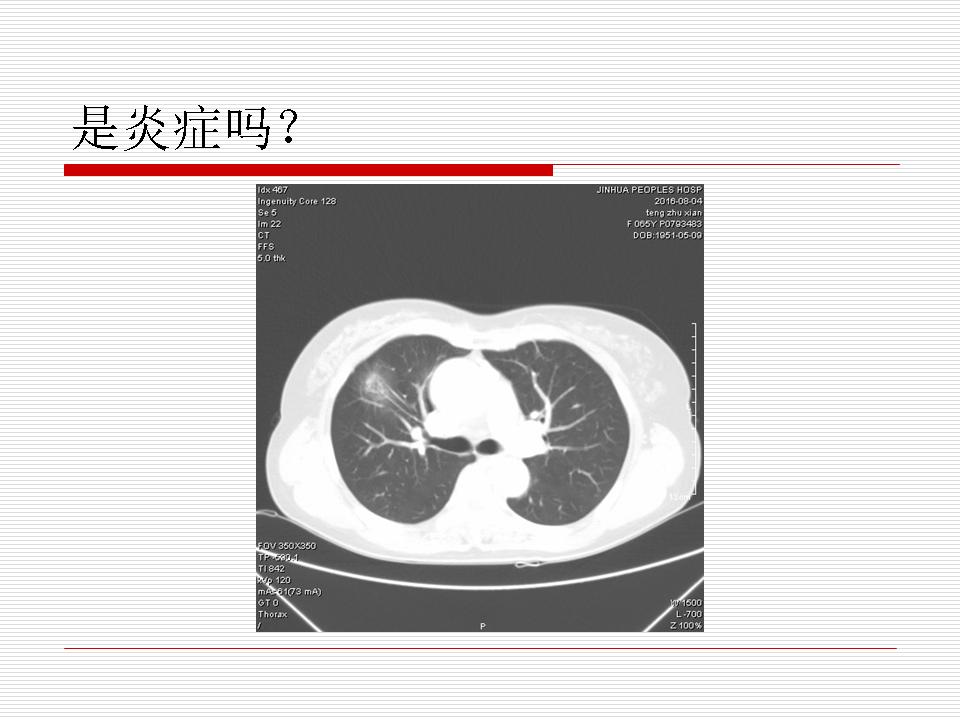 像炎症的肺癌能治好吗,医生说可能是肺癌也可能是炎症