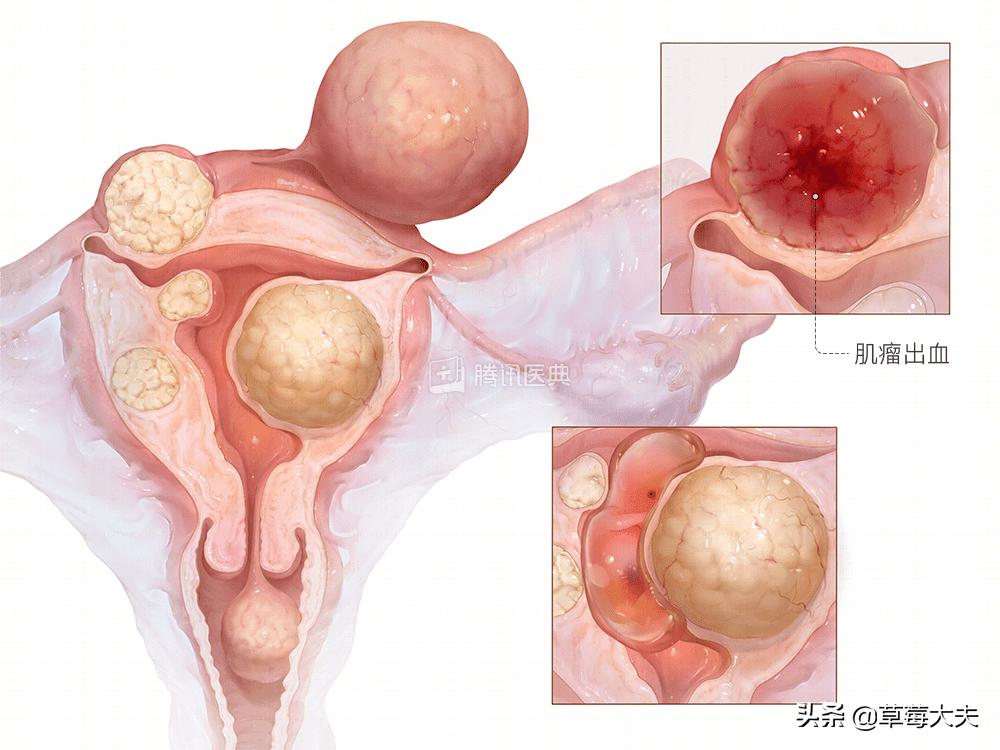 医生也成“催生婆”?不!是你输卵管出问题了......