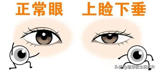 当你老了，上眼皮松了，其实恢复年轻并不难...