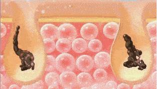 洗澡搓泥后起疙瘩,洗澡时搓出来的泥是怎么回事