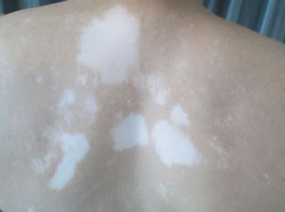 白癜风最快扩散方法,白癜风扩散期怎么治疗最快