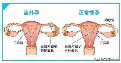 免疫问题怀孕必须保胎吗,免疫相关不良妊娠答疑