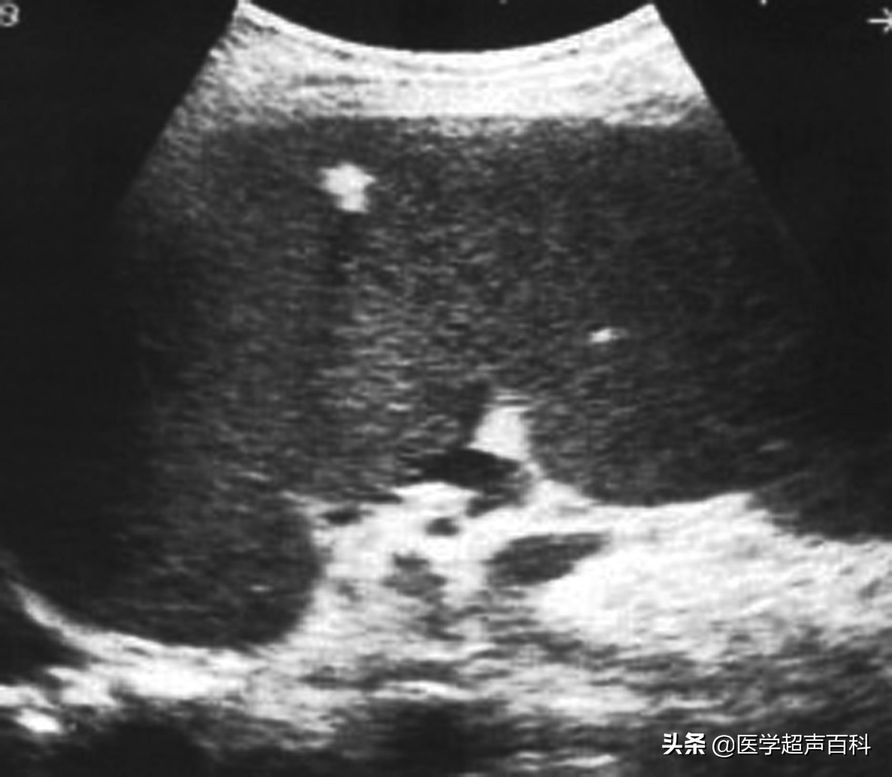 人体最大的淋巴器官是脾吗,脾是人体中非常重要的淋巴器官