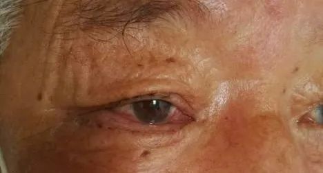 眼整形修复权威科普,科普眼整形手术是个什么手术多图