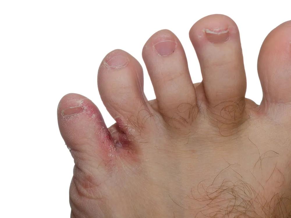 天热有脚气怎么去除脚臭,冬天脚气脚臭怎么办