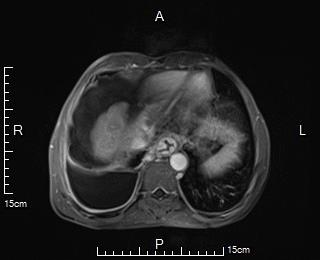 肝硬化引起门脉高压消化道出血,肝硬化消化道大出血怎么治疗