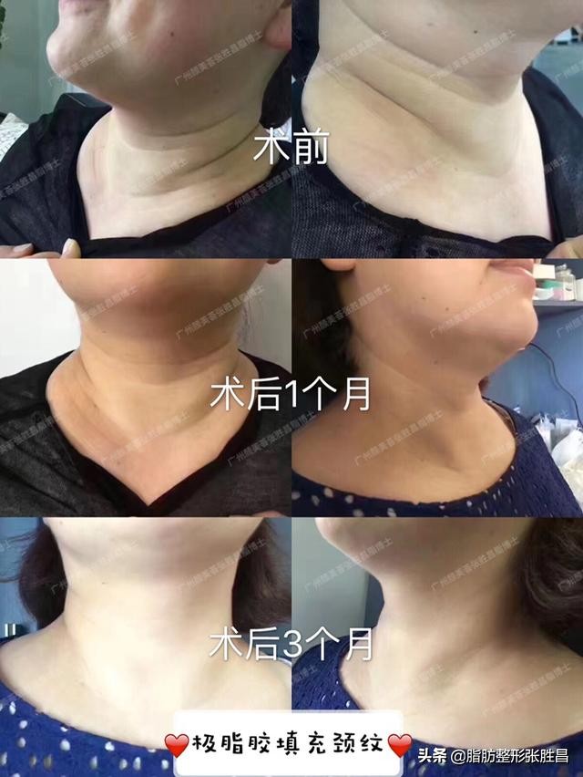 颈纹太多又显老，但常规方法祛除总是不能持久？做这个就可以了