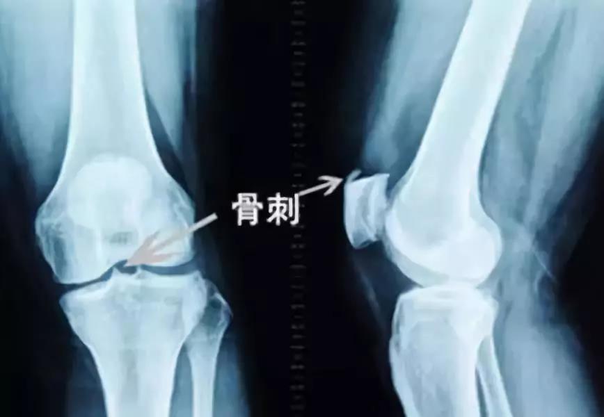 预防骨刺和骨退化,老年人长骨刺锻炼方法