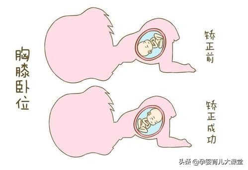 37周脐带绕颈2圈矫正图片胎位不正,孕妇胎位不正的原因及纠正方法