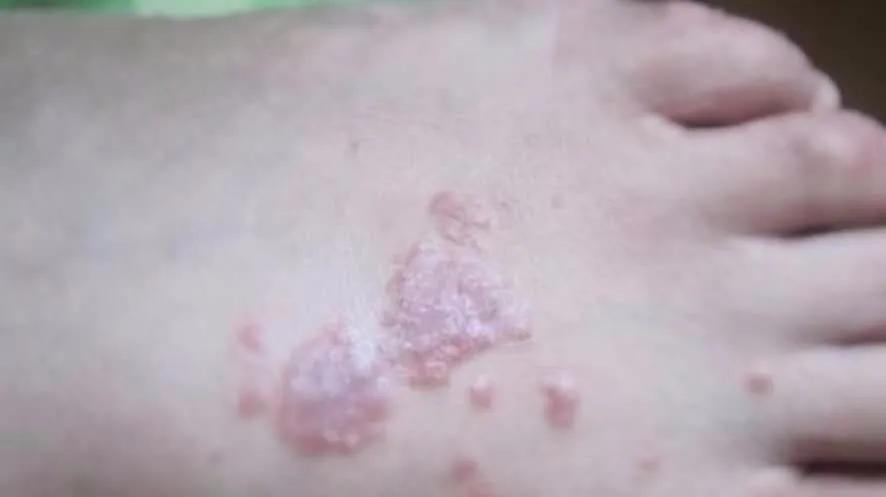 冀连梅治脚气最佳方法,用这个小方法彻底根治脚气