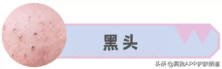 脸上长痘痘反反复复该怎么办,脸上一个部位反反复复长痘痘