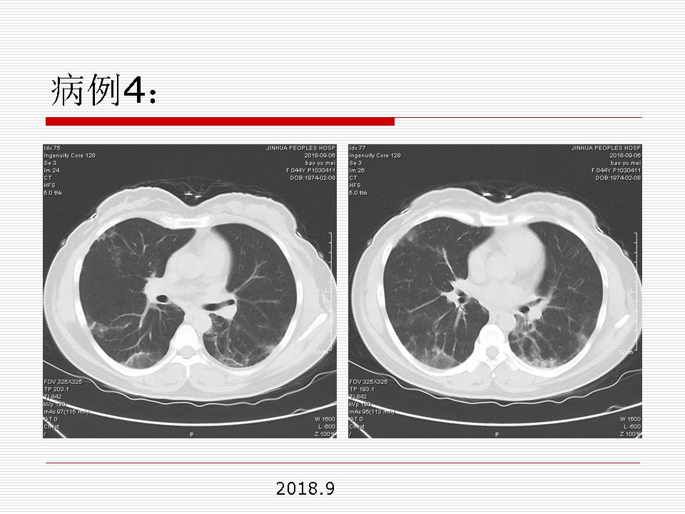 像炎症的肺癌能治好吗,医生说可能是肺癌也可能是炎症