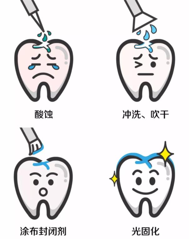 牙齿窝沟封闭多长时间可以刷牙,做完窝沟封闭当天可以刷牙吗