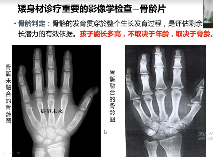矮小症和晚长的区别,矮小和晚熟的区别