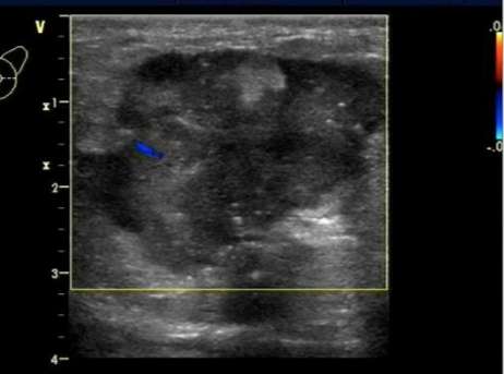 乳腺彩超报告中隐藏的秘密,乳腺结节4a怎么判断良性还是恶性