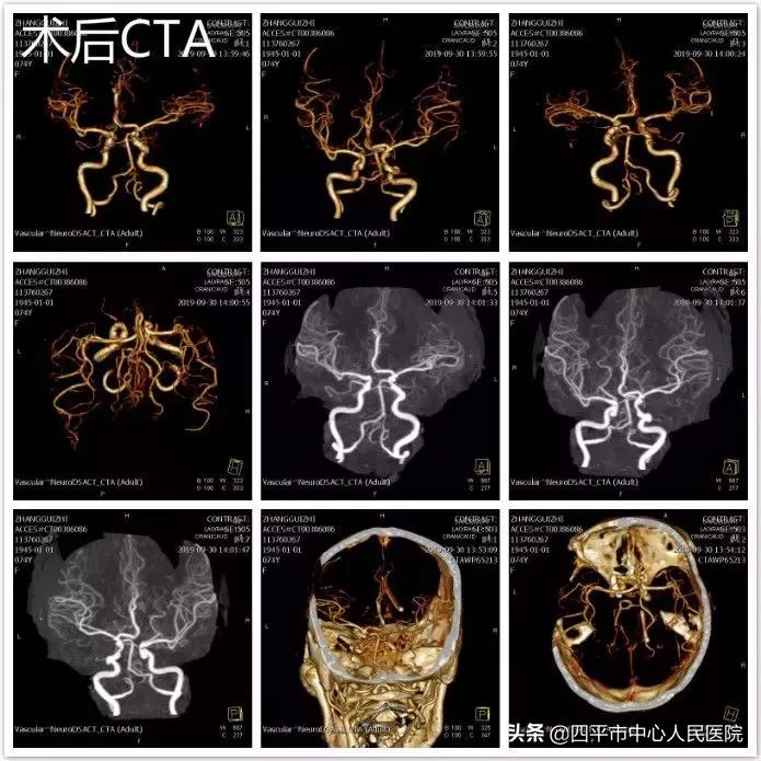 精准排雷再现新高—神经外科在6月份成功救治6例颅内动脉瘤患者