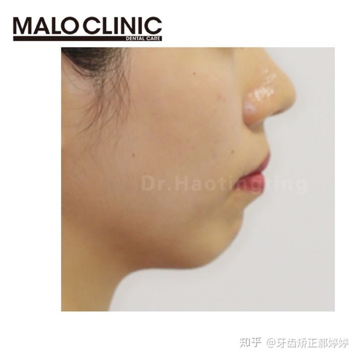 上海成人牙齿矫正失败案例,上海牙齿矫正郝婷婷医生