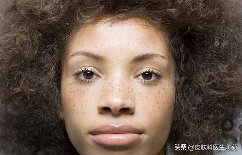 脸上激光了能喝中药吗,激光祛斑可以喝中药吗