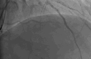 32岁北大博士心梗猝死,知名医生突发心梗