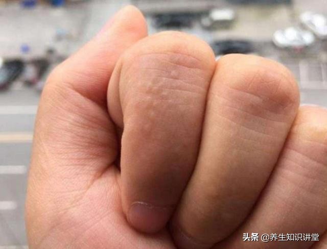 手上长密密麻麻水泡很痒涂什么药,手上长小水泡很痒可以把泡刺破吗