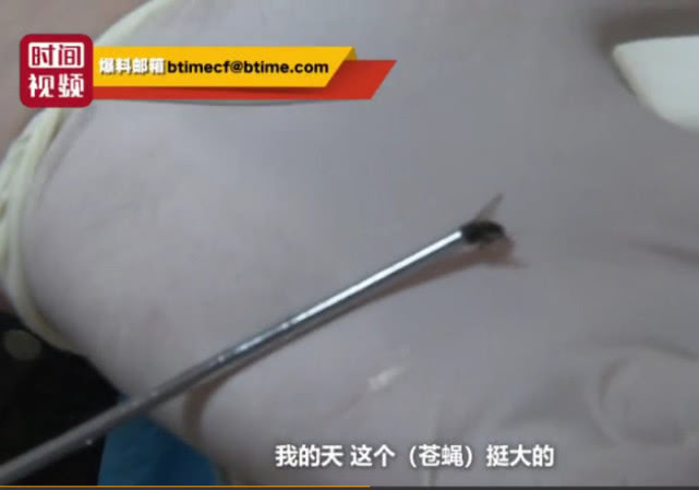 苍蝇飞进耳朵挣扎一会没动静了,苍蝇飞进小伙耳道医生妙招取出