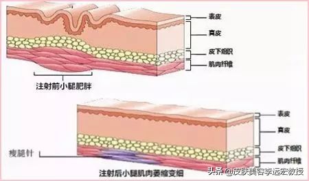 大腿粗小腿细怎么拯救,大腿小腿粗怎么减才有效