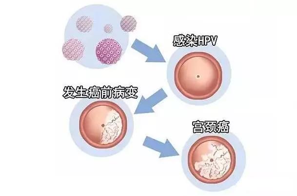 hpv和tct检查阳性还能不能打九价,hpv和tct检查都没事但是有宫颈癌
