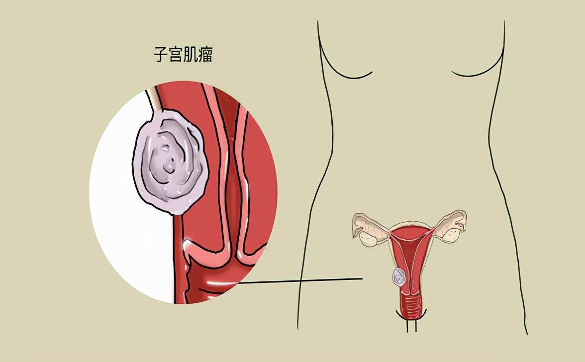 豆制品子宫肌瘤能吃吗,豆制品对子宫肌瘤有影响吗