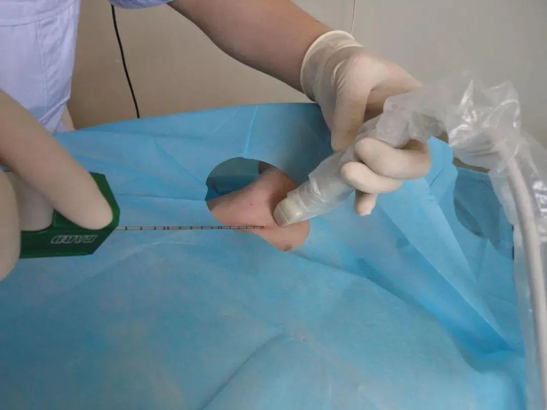 甲状腺微小癌消融术好还是切除好,甲状腺微小癌1期