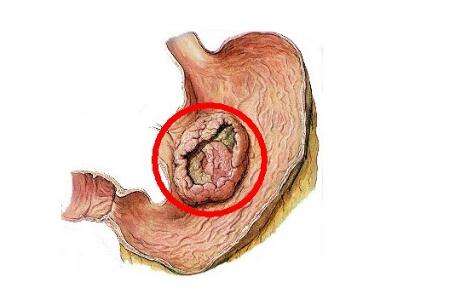 胃癌化疗期间的饮食食谱,胃癌肝转移化疗饮食