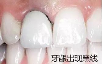 全瓷牙和烤瓷牙到底哪个好,烤瓷牙和全瓷牙优缺点及价格