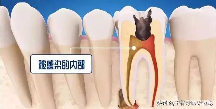 牙坏了医生说保不住为什么不给拔,牙崩了一半怎么补牙