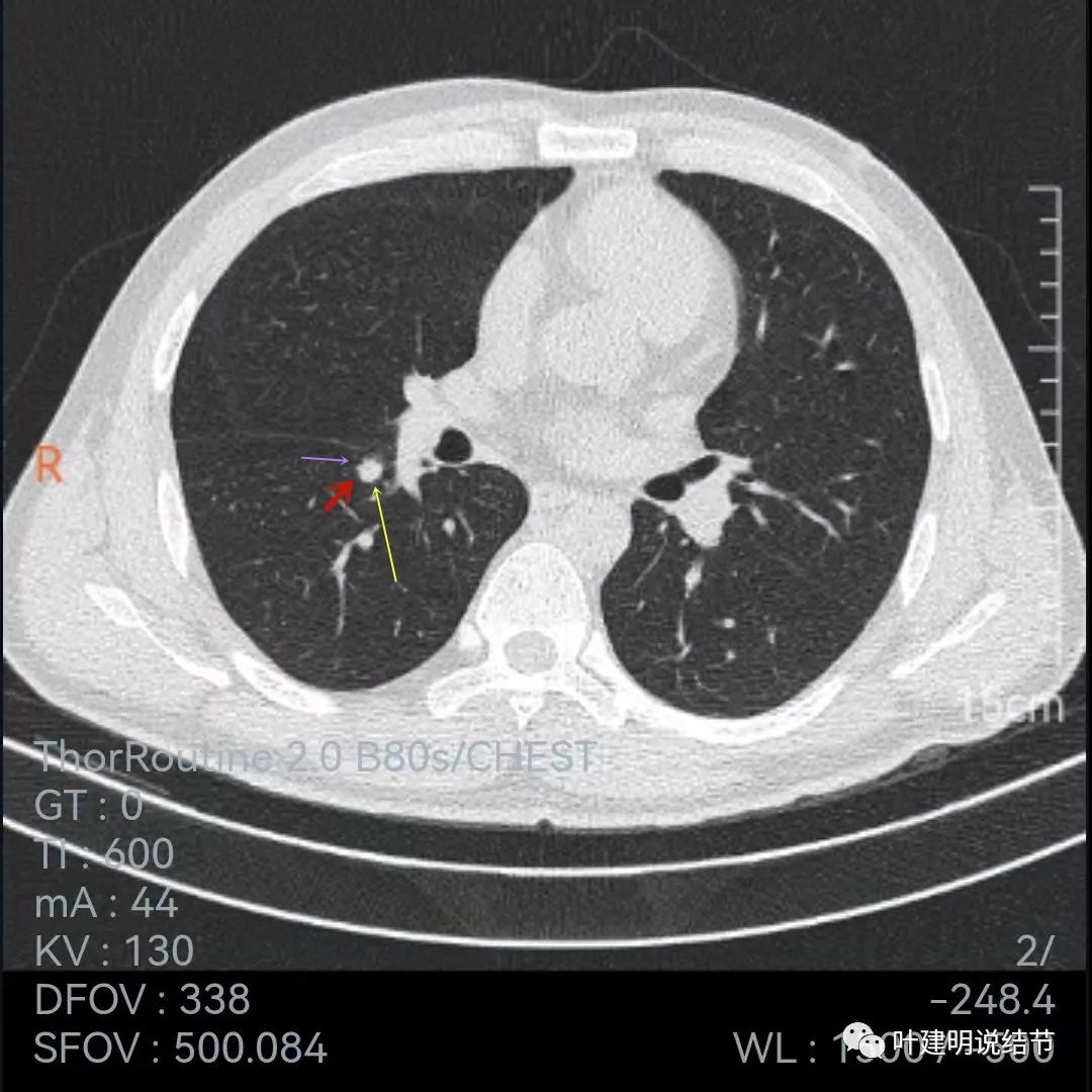 问诊分析:存在了4年的实性结节会不会是肺癌?