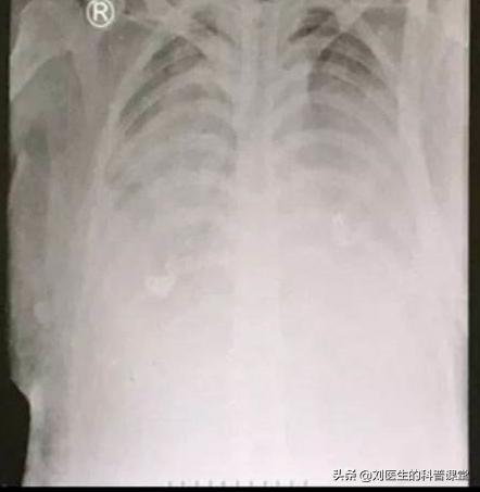 新型冠状肺炎有效治疗措施,新型肺炎防控三个必须