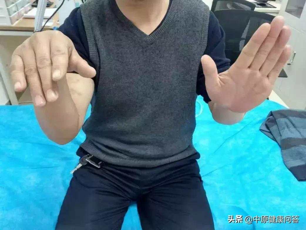 酒后摔伤手指麻木无力不愈,酒后手指麻木无力